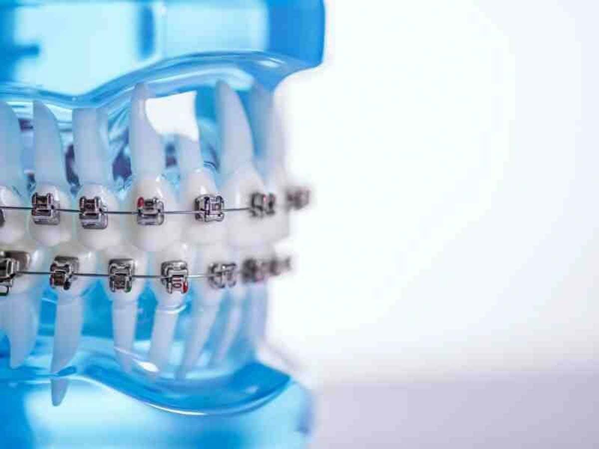 KLOwen Orthodontics Unveils Custom Metal Self-Ligating Solution. Image credit: © KLOwen Orthodontics